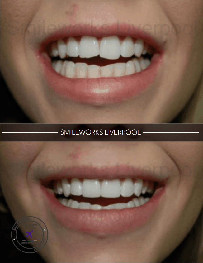 composite veneer before and after