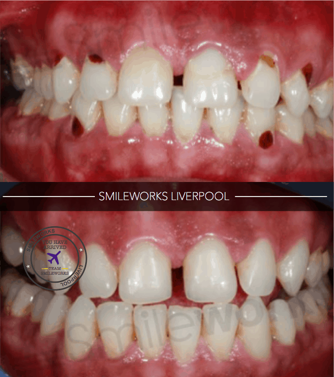 Composite fillings 2018