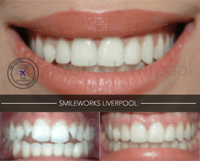 composite veneer before and after