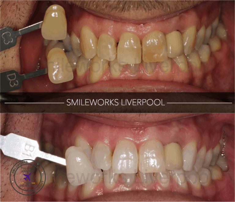 Teeth Whitening Liverpool Beautiful, Bright and Responsible