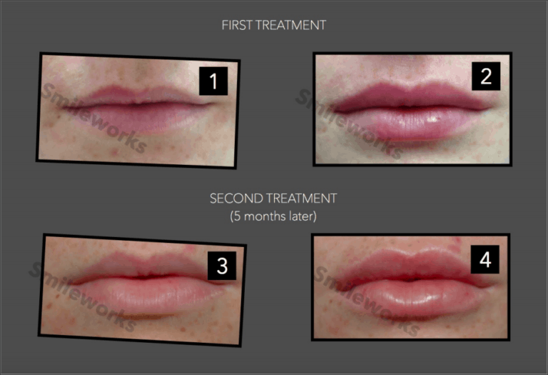 Lip Fillers gone wrong? Dissolve filler with Hyalase Advice & Cost