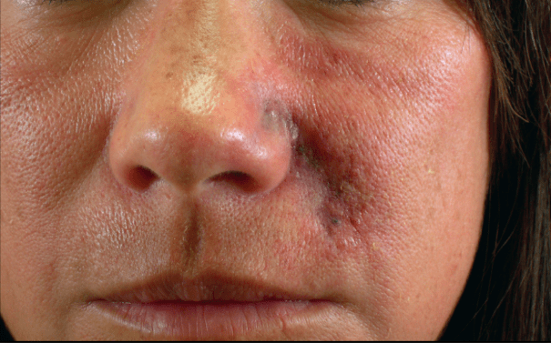 vascular complication of nasolabial folds causing necrosis