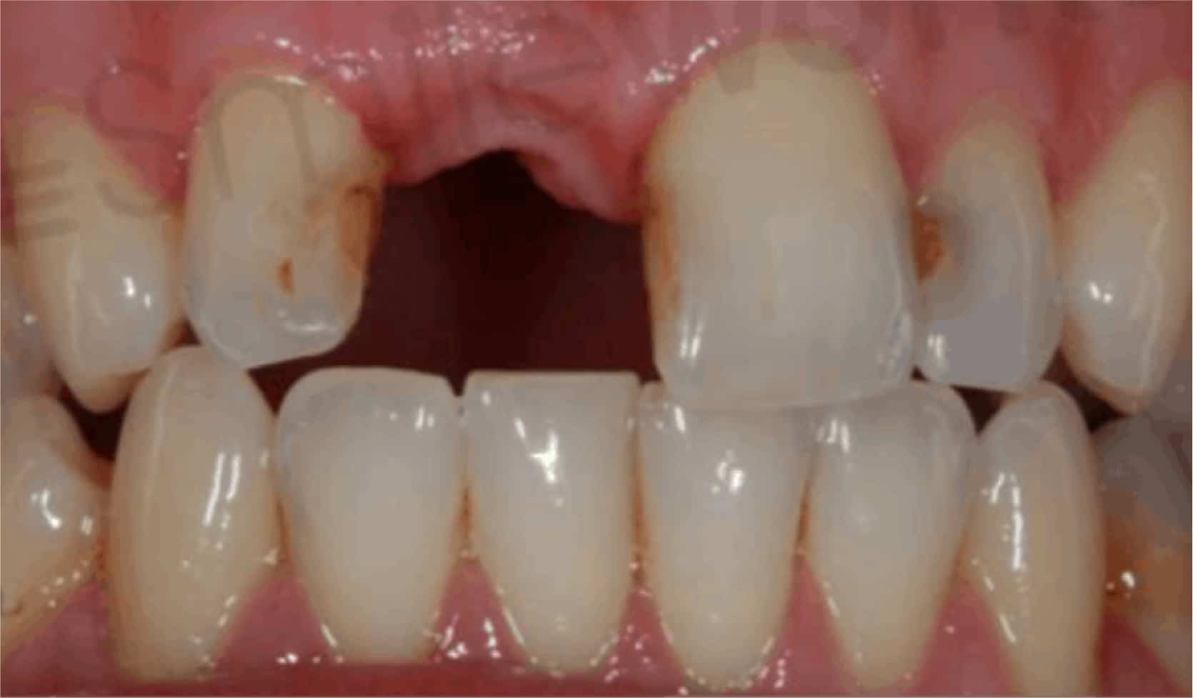 Dental Implants Liverpool 94 m Cost Replace Missing Teeth In 2019