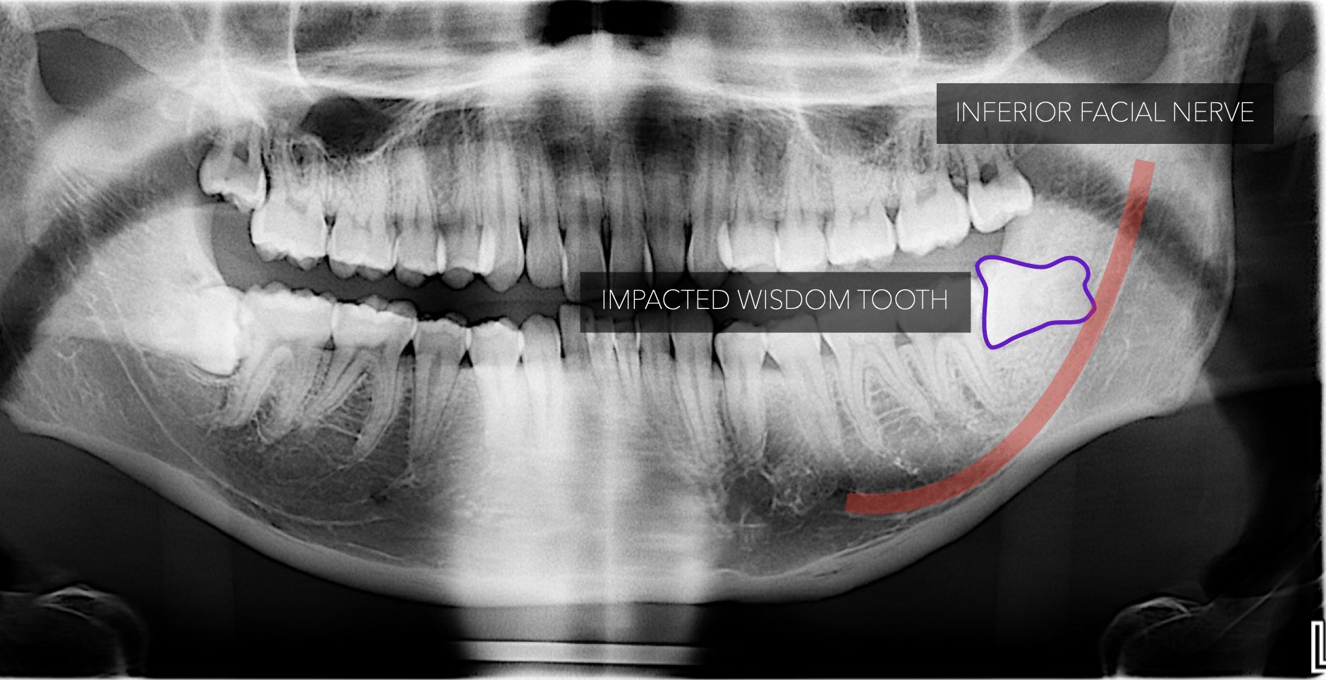 Impacted Tooth In Clost Proximity to Inferior dental nerve