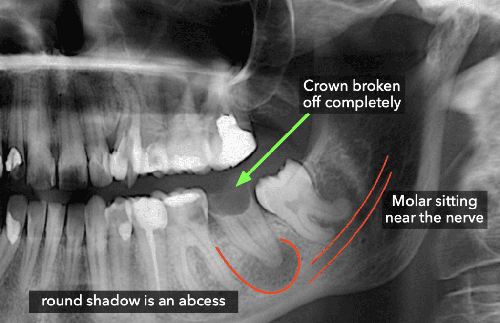 Broken crown with abcess