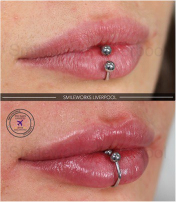 lip filler with piercing