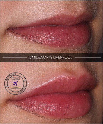 Lip fillers liverpool