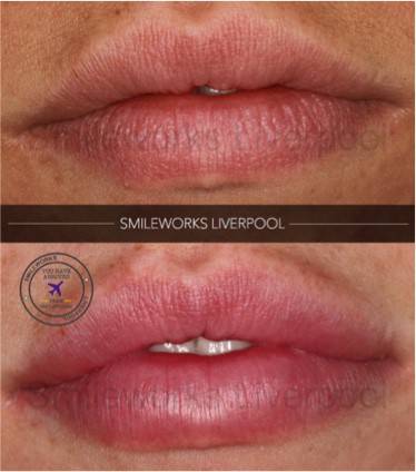 full lips filler