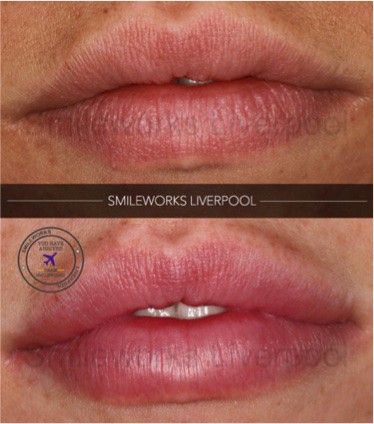 full lips filler