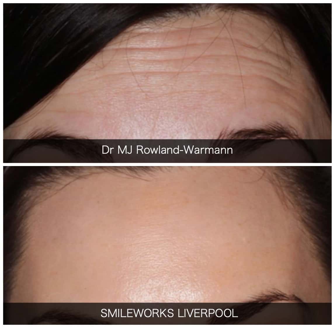Botox Liverpool Breathtaking Precision & 2023 Prices
