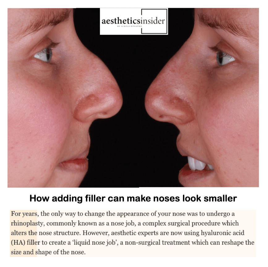 Aesthetics insider
<br/>
<br/>
How adding filler can make noses look smaller