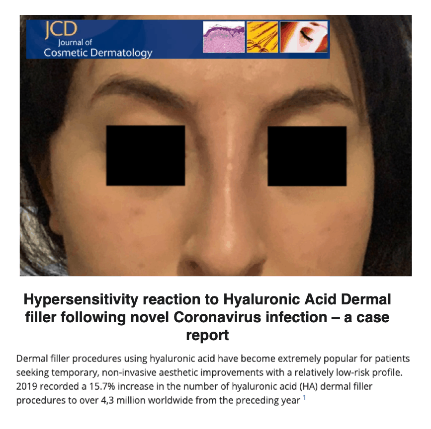 Journal of Cosmetic Dermatology
<br/>
<br/>
Hypersensitivity reaction to Hyaluronic Acid Dermal filler following novel Coronavirus infection - a case report