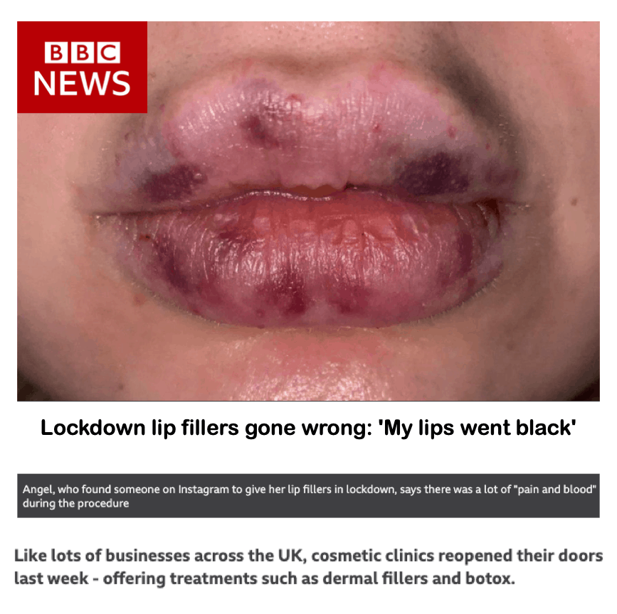 BBC News
<br/>
<br/>
Lockdown lip fillers gone wrong: ' My lips went black'