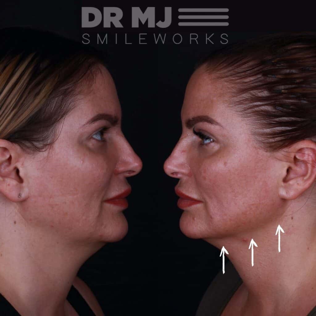 skin tightening jawline