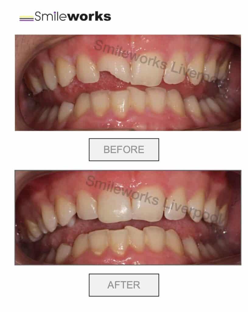 Composite Bonding Affordable Same Day Smileworks Liverpool