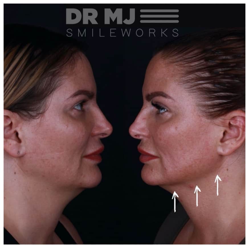 Jawline recontouring before and after