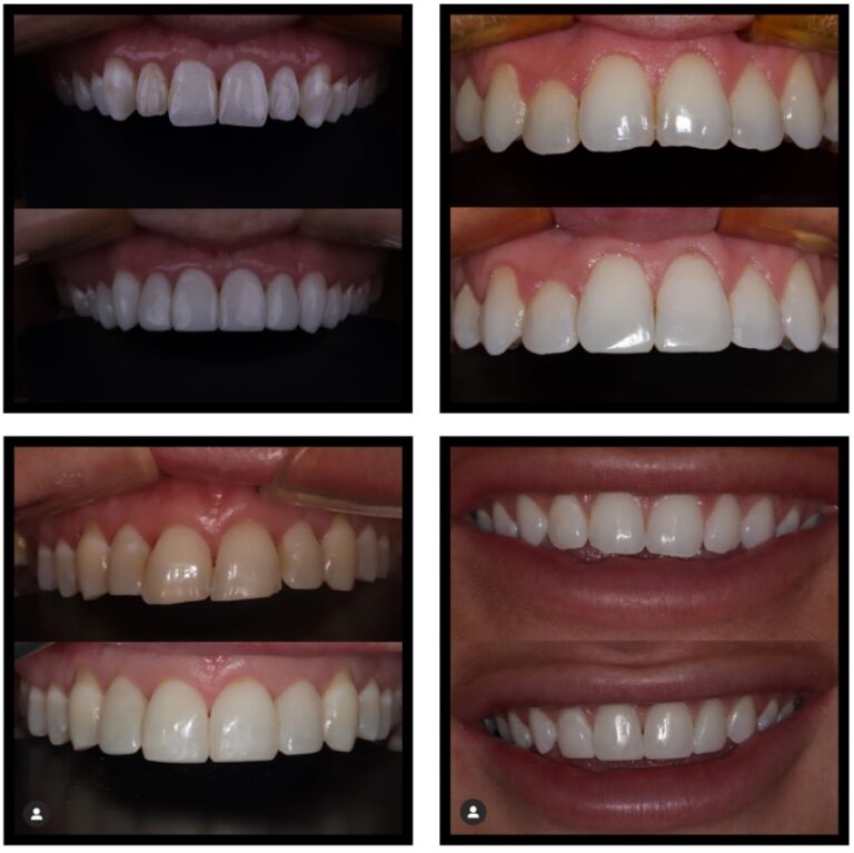 Composite bonding Liverpool “life changing” fix for uneven smiles