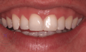 teeth whitening liverpool