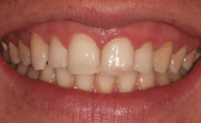 teeth whitening liverpool
