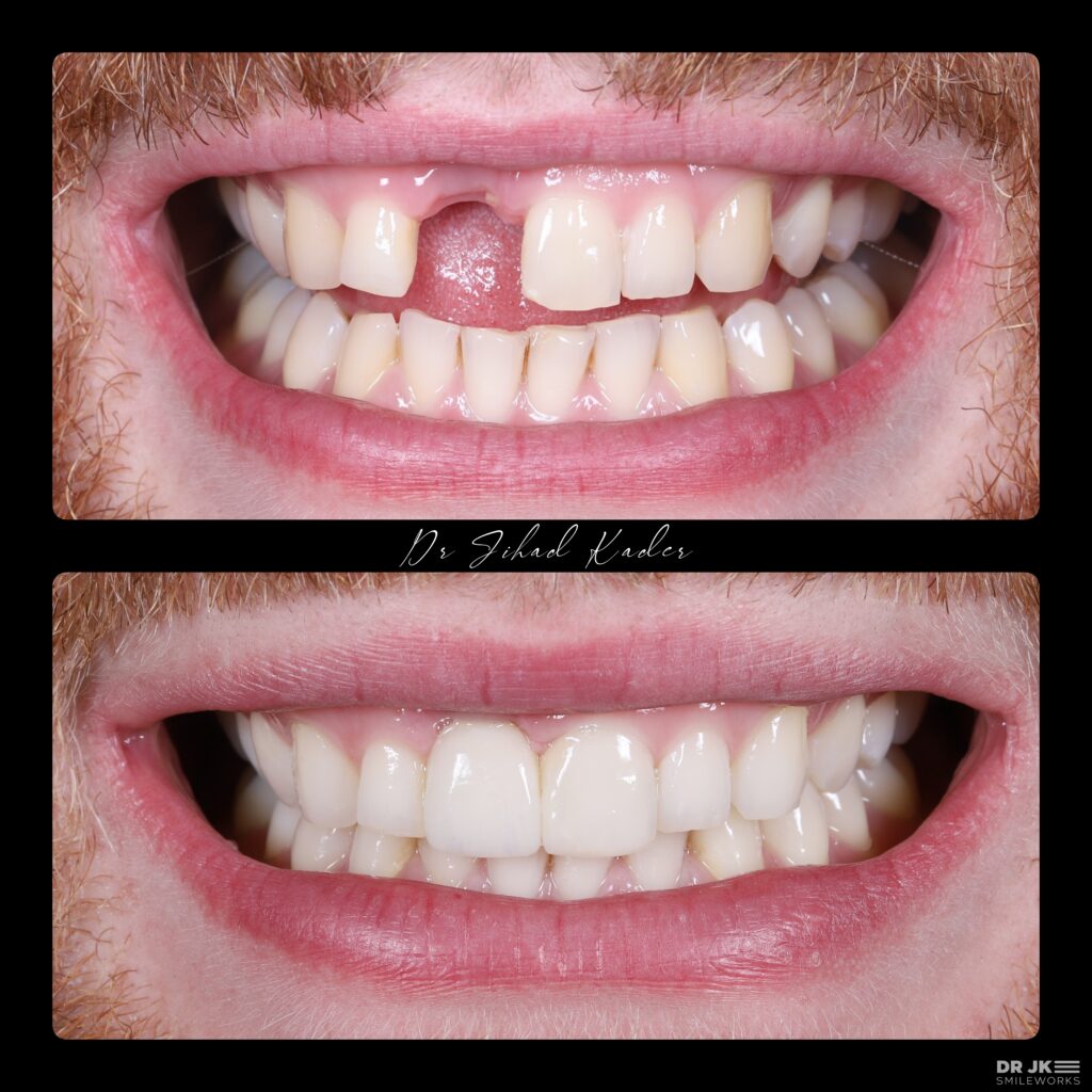 Dental Implants Liverpool £94/m cost Replace missing teeth in 2023