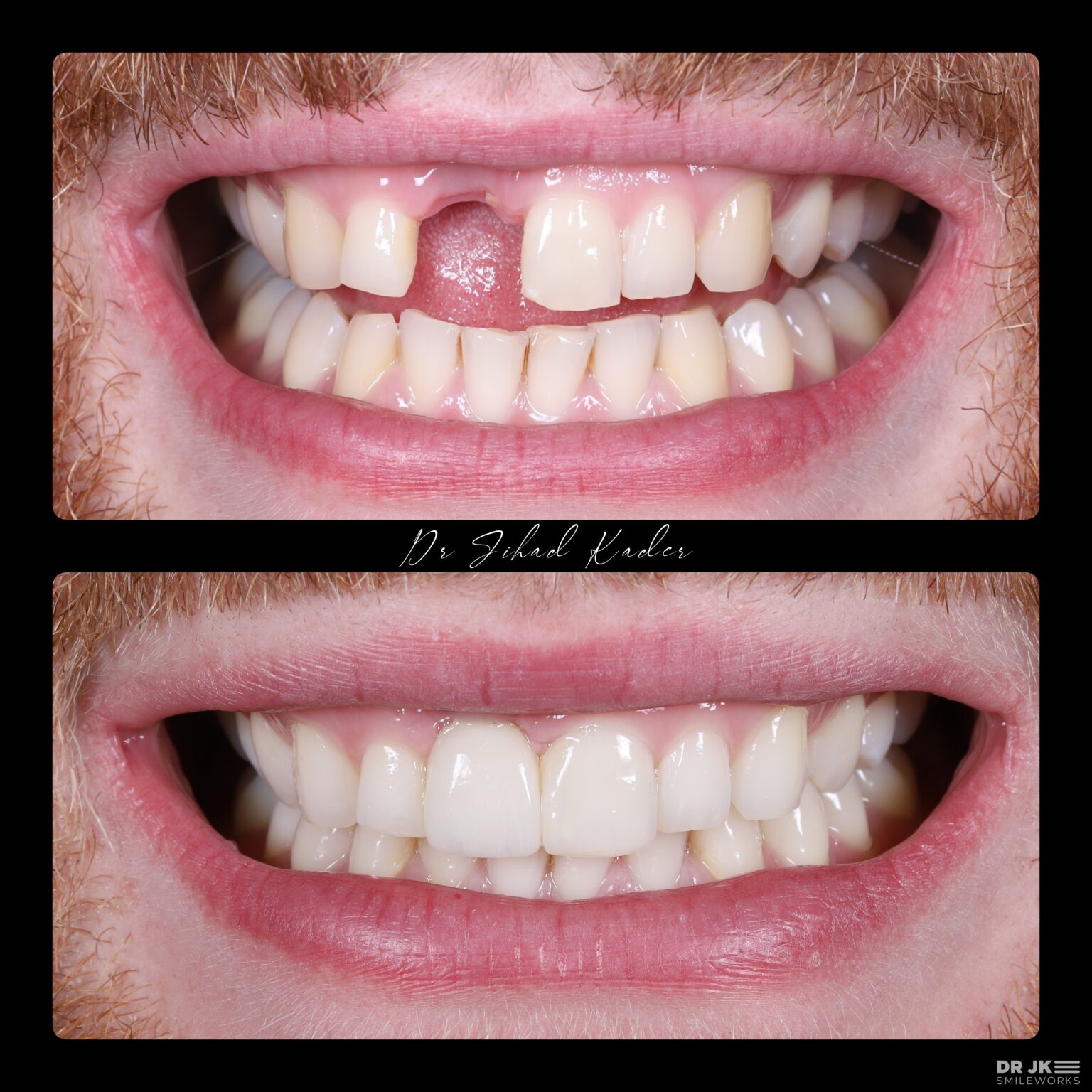 Dental Implants Liverpool £94/m cost Replace missing teeth in 2023