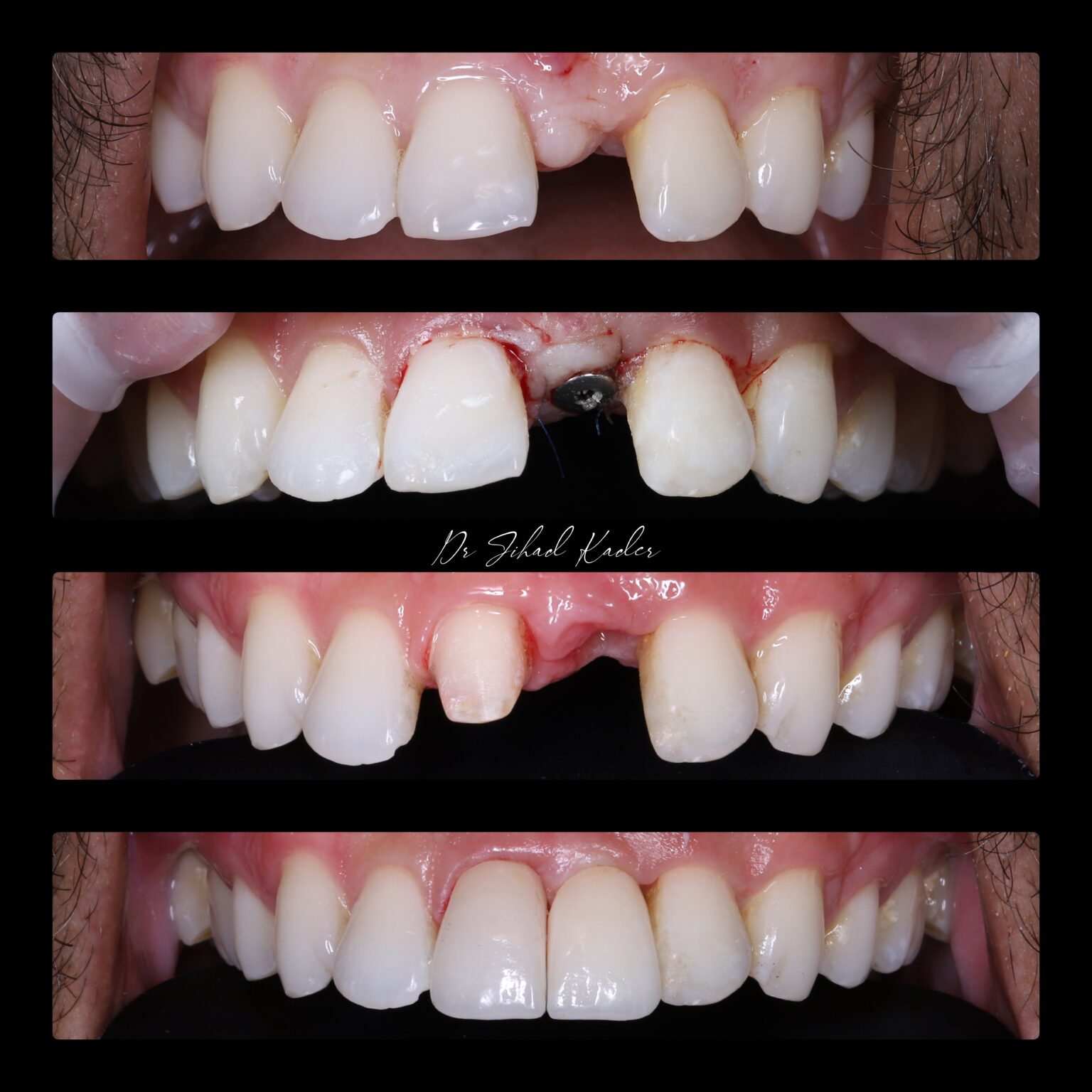 Dental Implants Liverpool £94/m cost Replace missing teeth in 2023