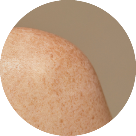 body hyperpigmentation body hyperpigmentation