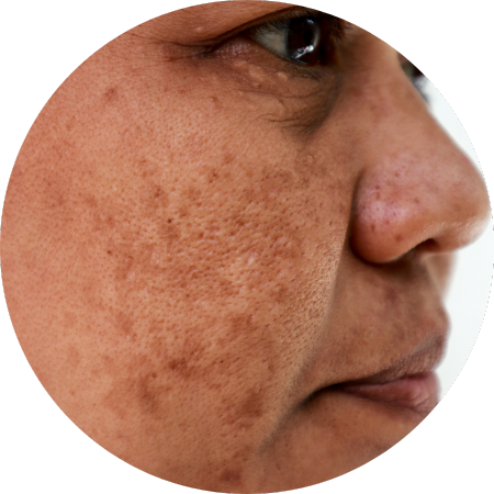 melasma hyperpigmentation