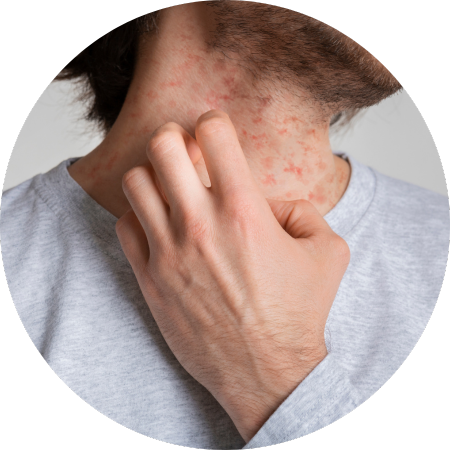 eczema hyperpigmentation eczema hyperpigmentation