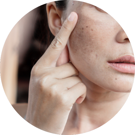 face hyperpigmentation hyperpigmentation face