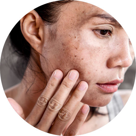 hyperpigmentation treatment