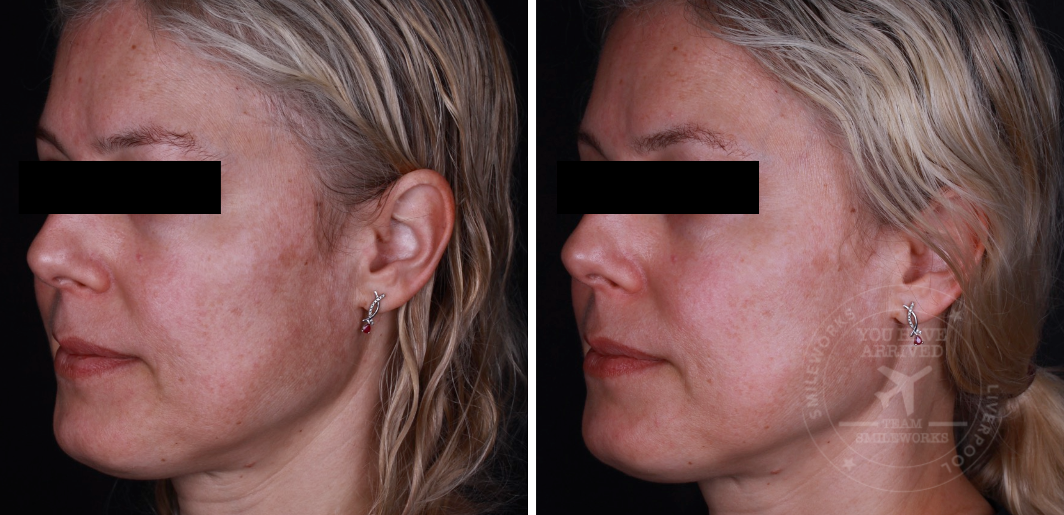 hyperpigmentation 1 hyperpigmentation 1