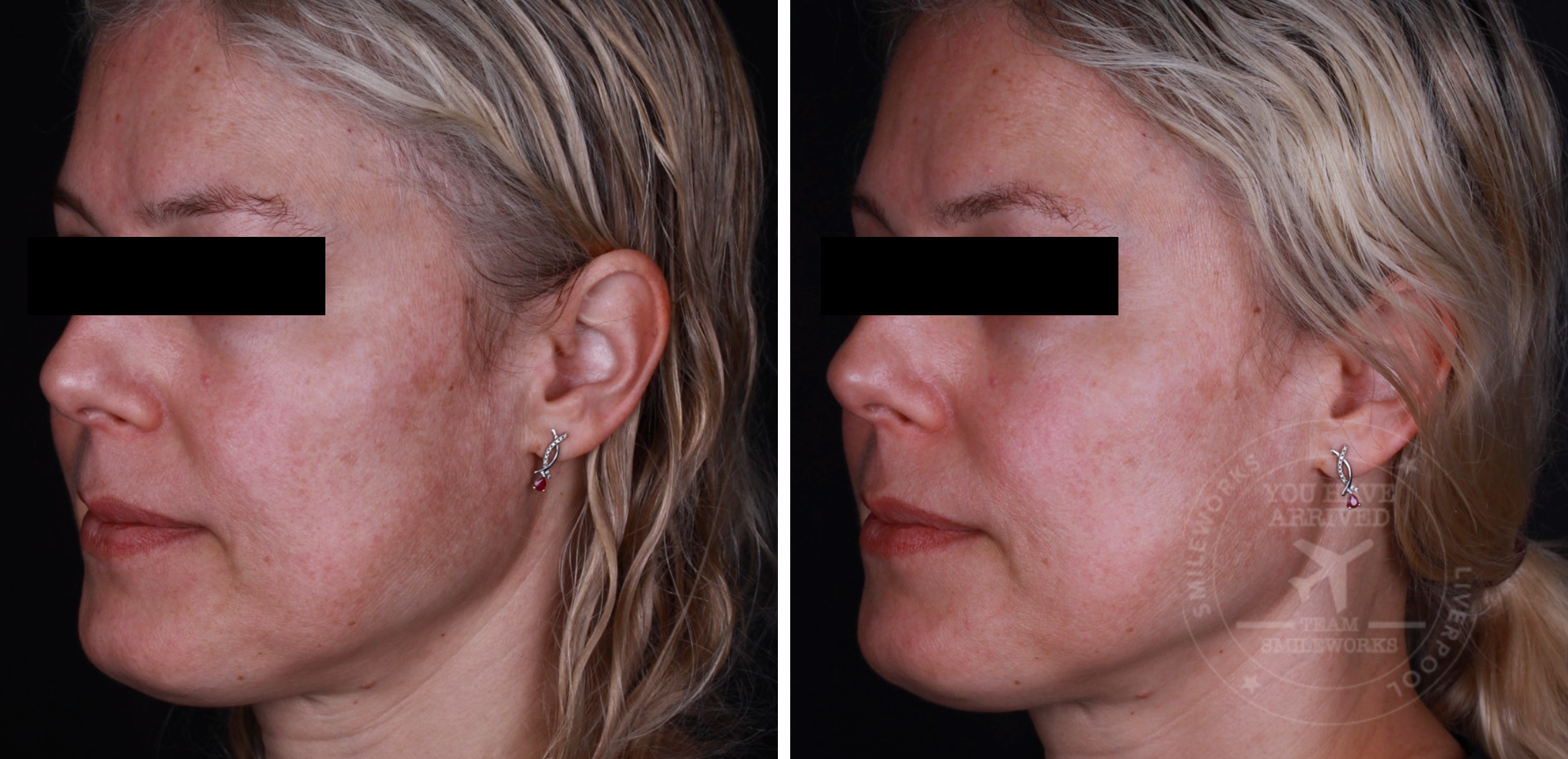 hyperpigmentation 1