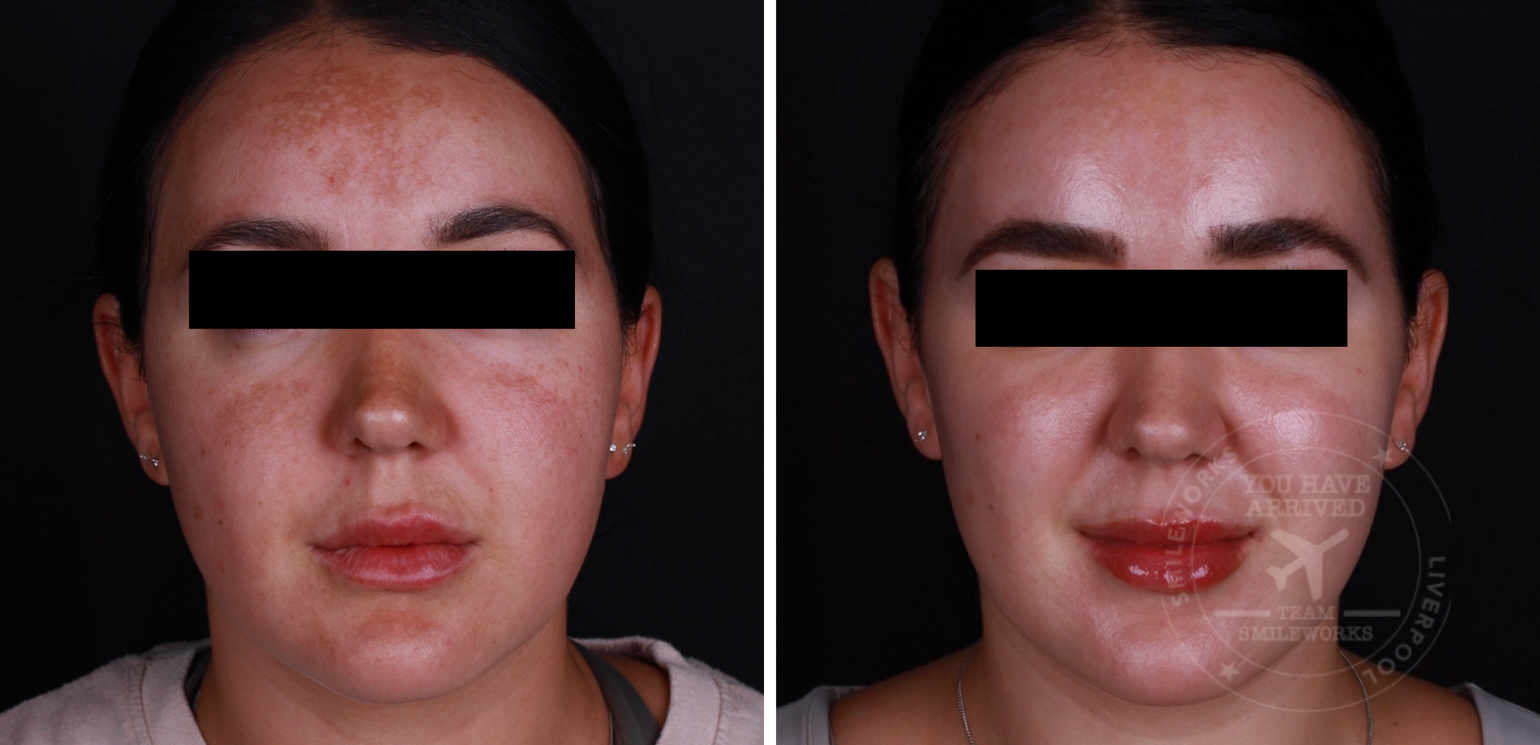 hyperpigmentation 2 melasma before and after
