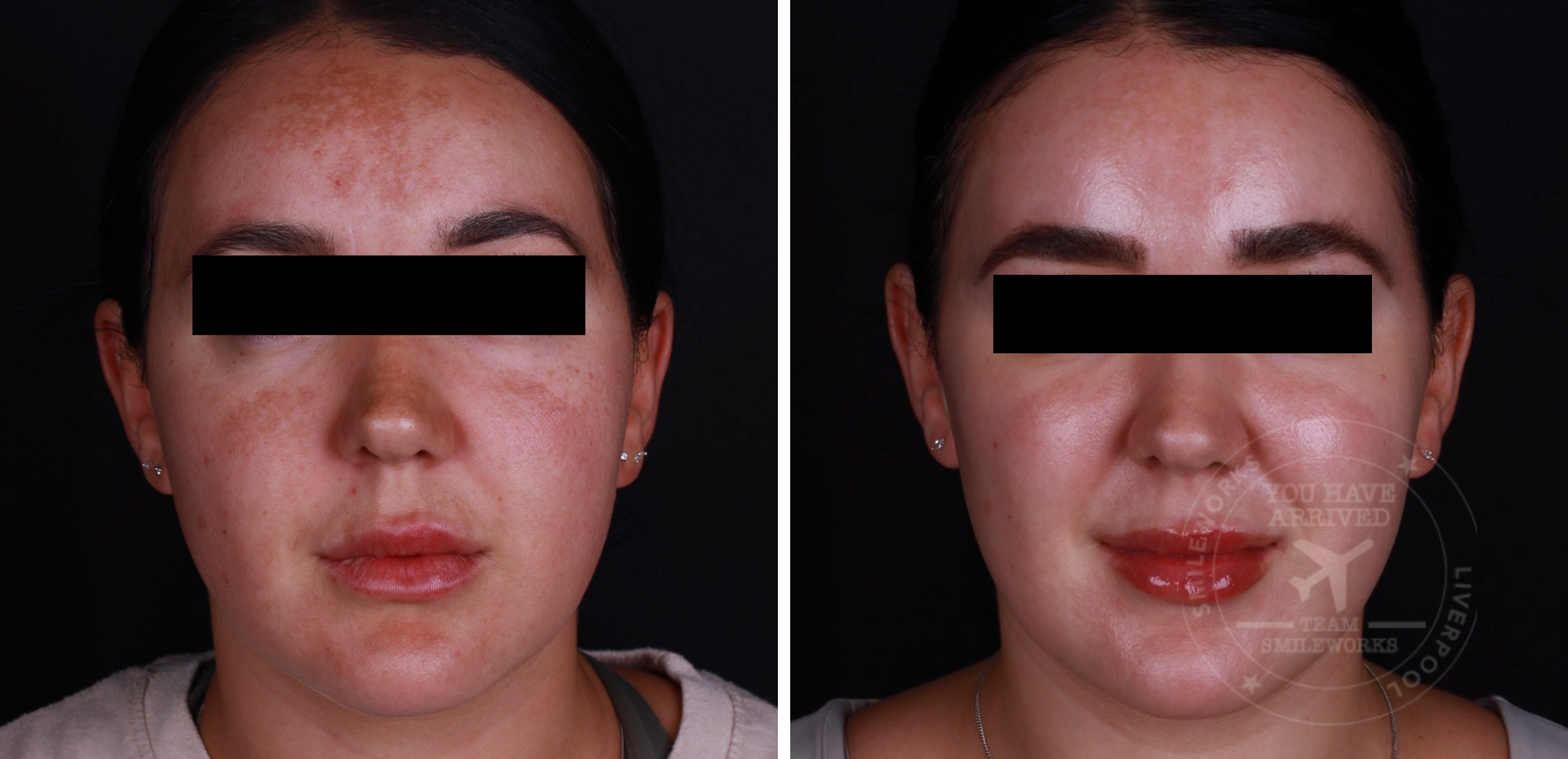 melasma before and after