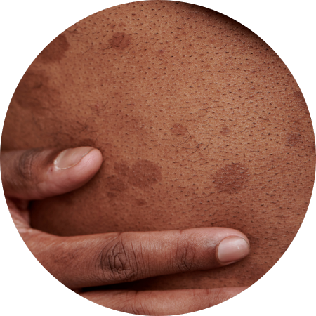 hyperpigmentation on black skin