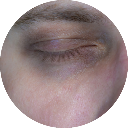 periorbital hyperpigmentation periorbital hyperpigmentation