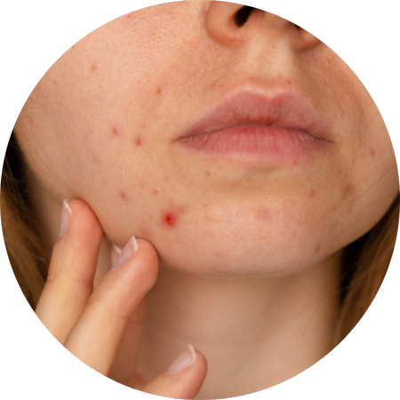 post inflammatory hyperpigmentation