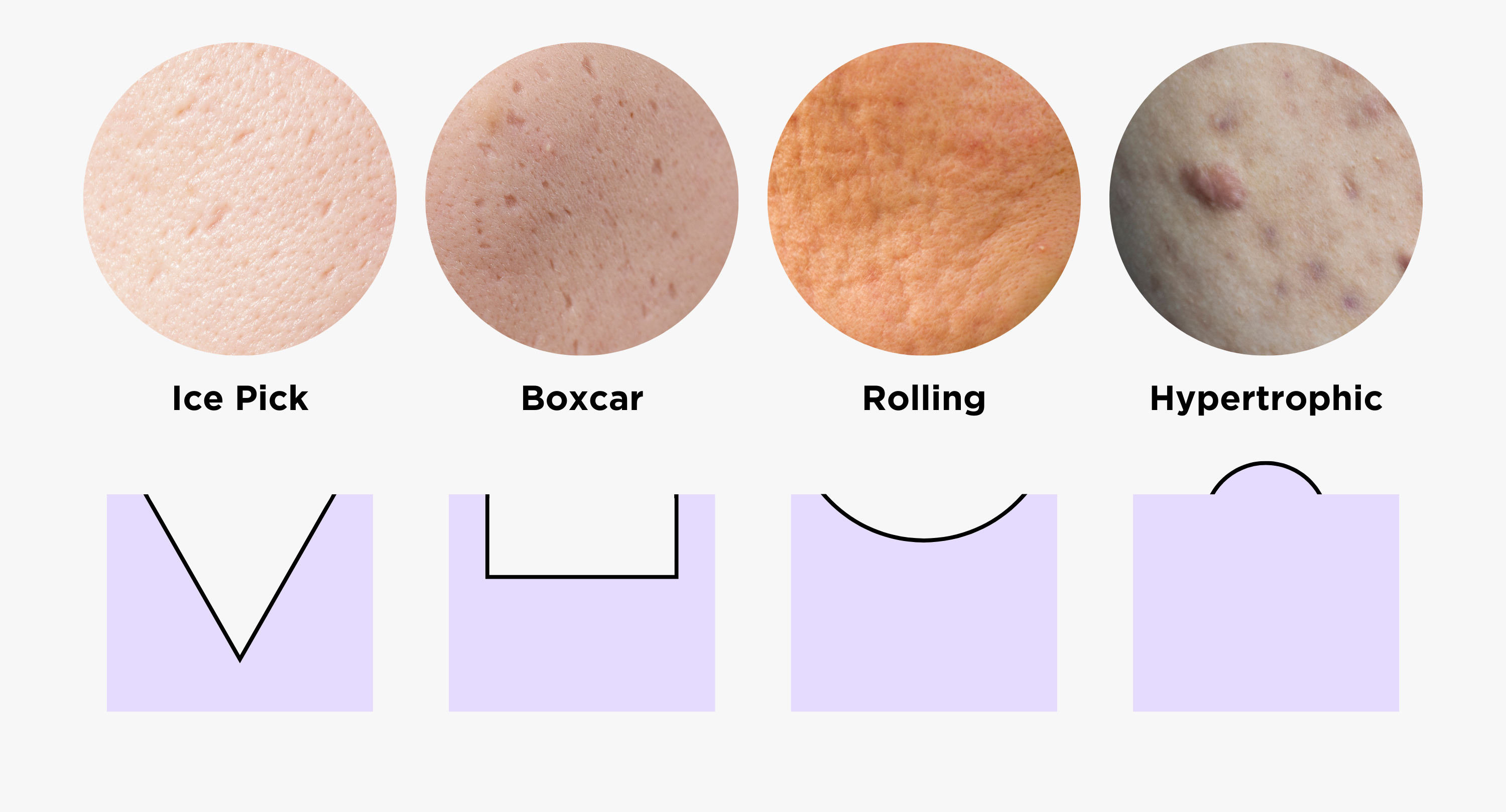 Acne face map & acne scar diagram (2)