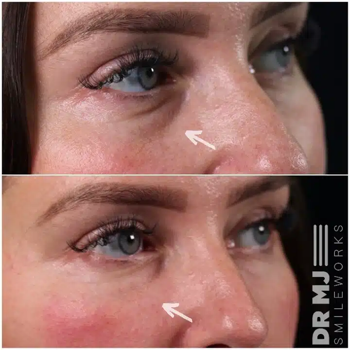 tear trough filler before and after