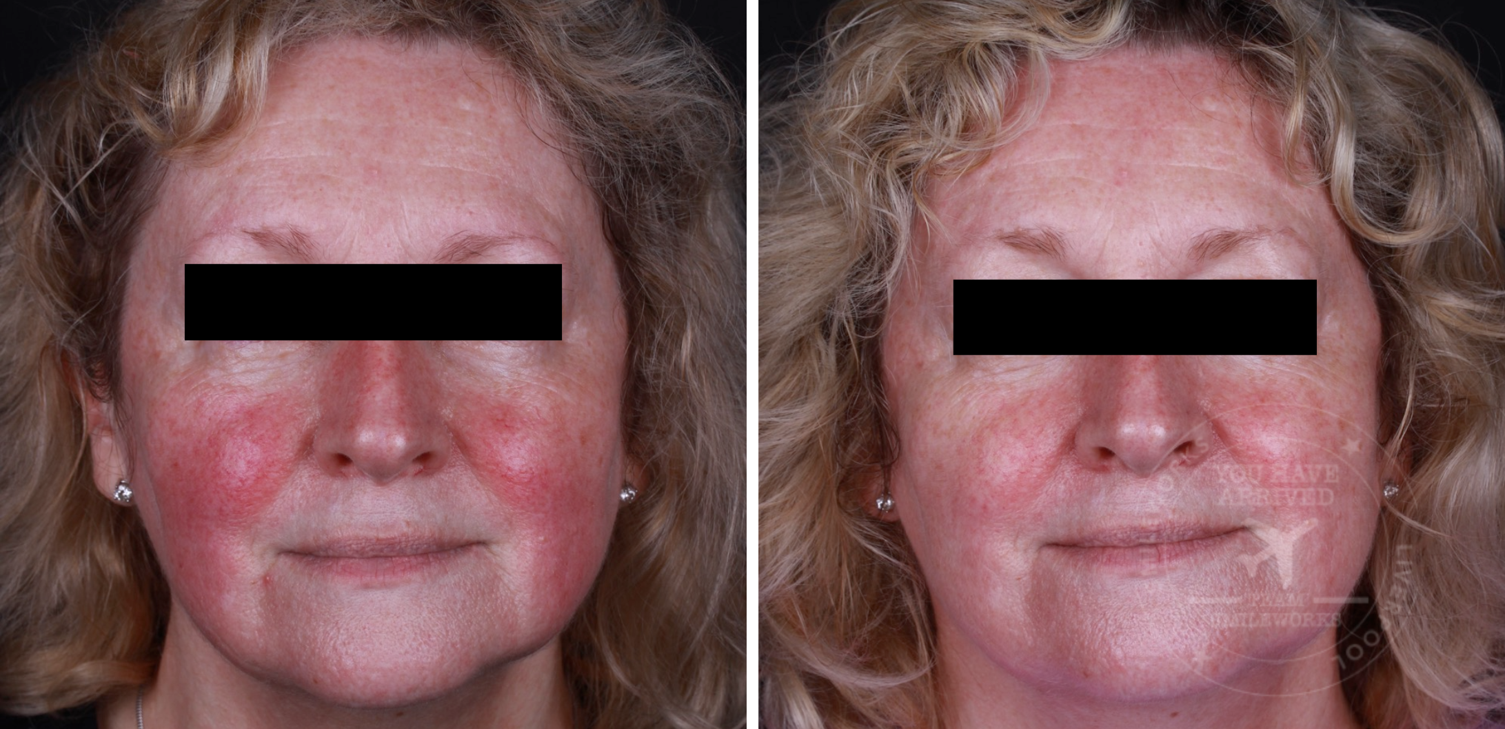 rosacea before and after