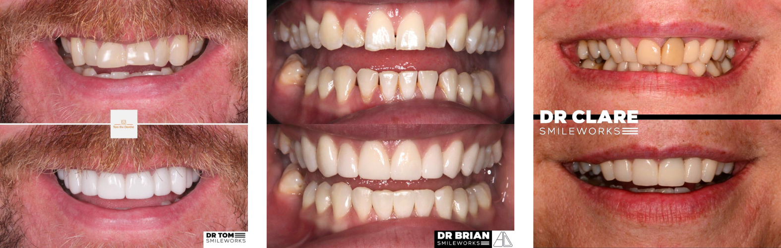 veneers liverpool