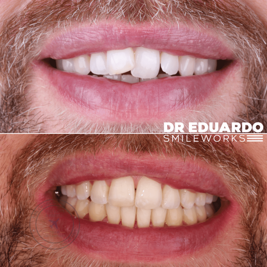 Spark Aligners Liverpool – Affordable, Effective Teeth Straightening