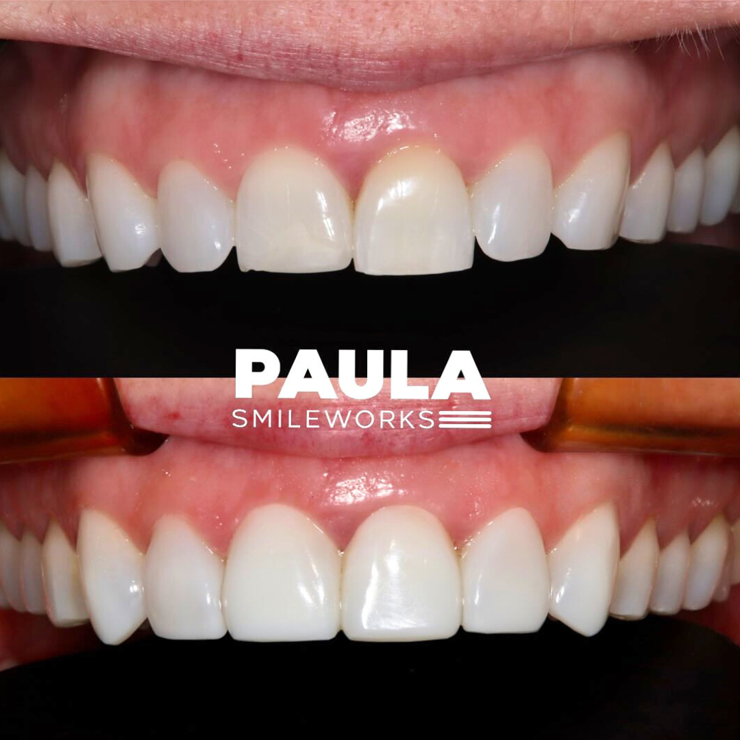 paula composite bonding paula composite bonding
