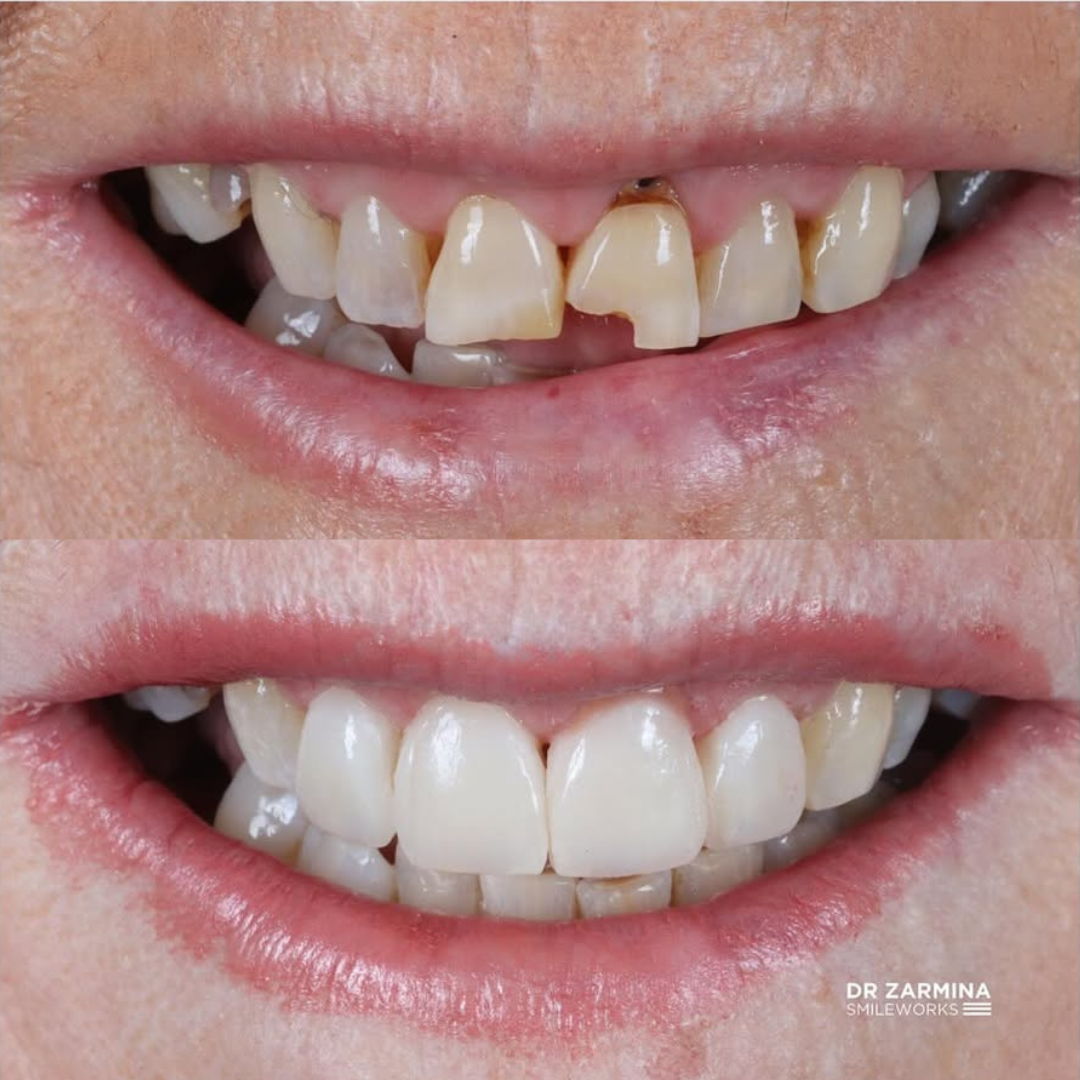 zarmina composite veneers zarmina composite veneers
