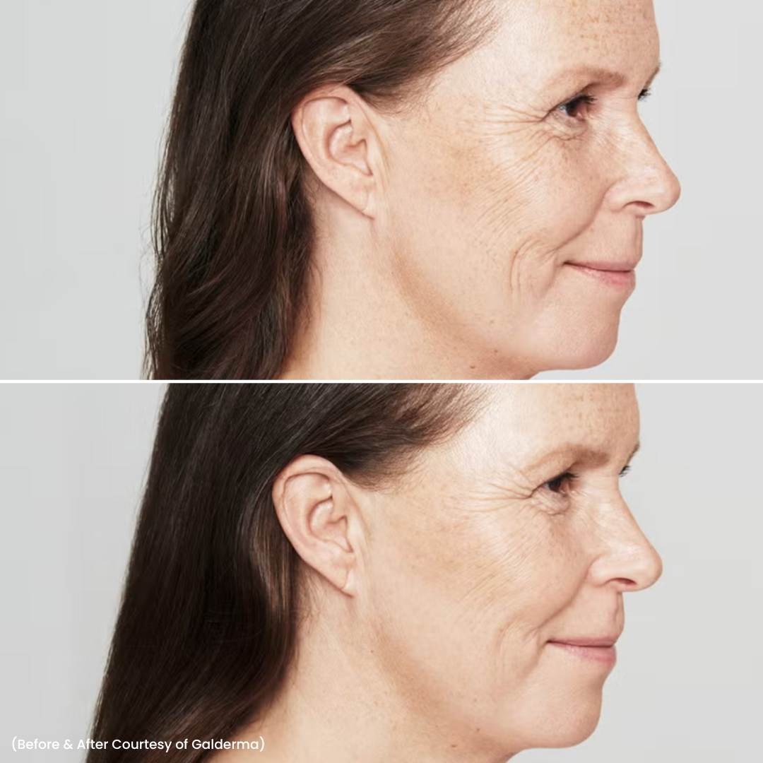 skin booster b&a 1
