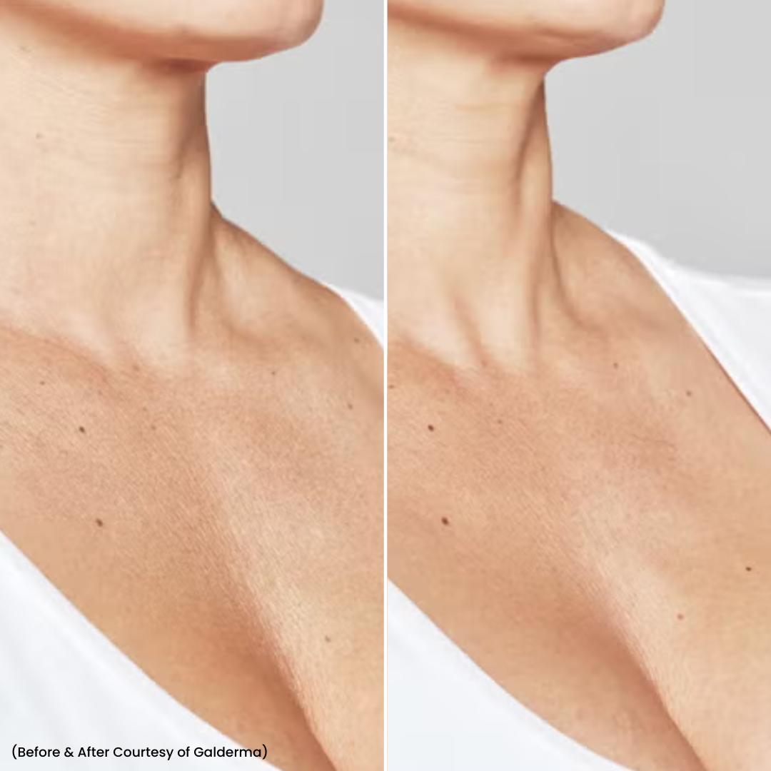 skin booster b&a 2