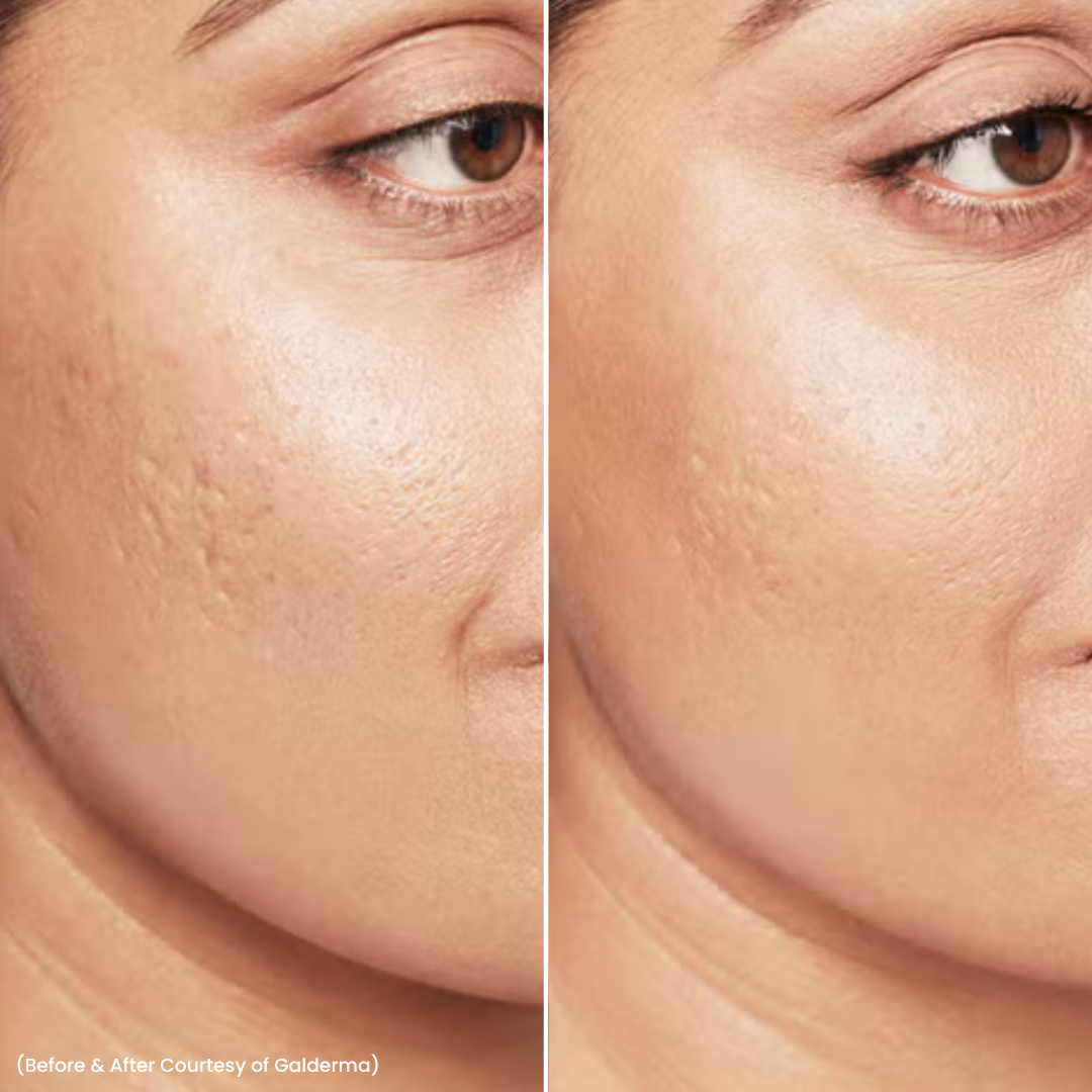 skin booster b&a 3