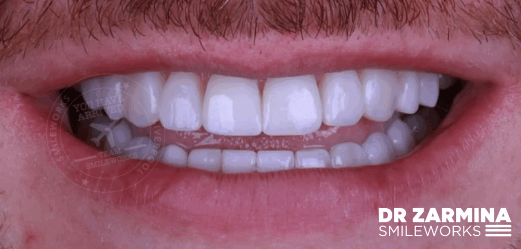 After composite veneers