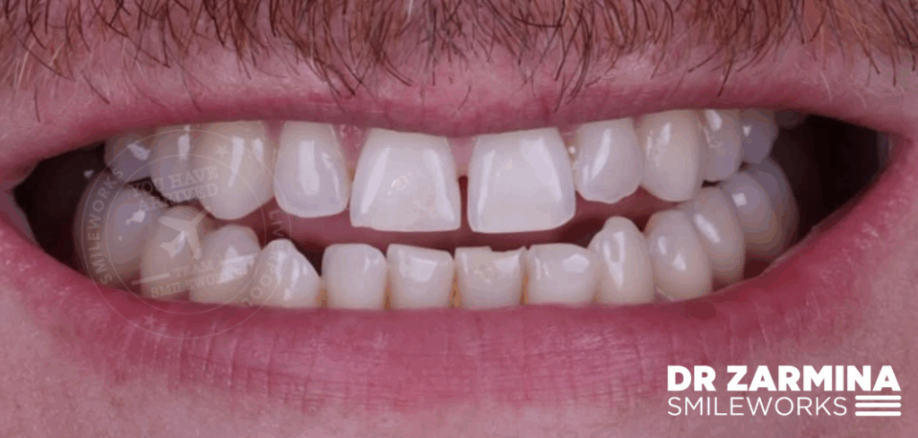 Before composite veneers